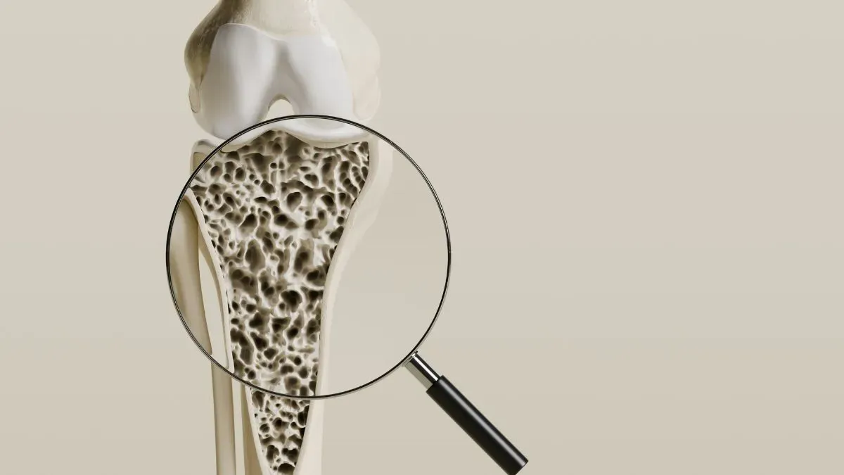 osteoporosis