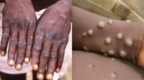 monkey pox