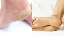 eauty and Personal Care, Home Remedies