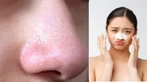 blackheads