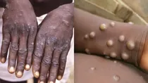 monkeypox testing 