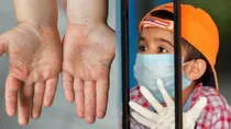 Hand, foot and Mouth disease
