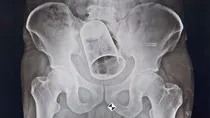 Steel glass removed from Intestine of man in Odisha Berhampur