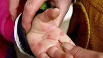 Tomato Flu cases in India