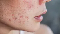अगर PCOS है तो उसके कारण होने वाला एक्ने आम एक्ने से अलग होता है