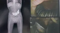 187 Coins removed from Man's Stomach Karnataka