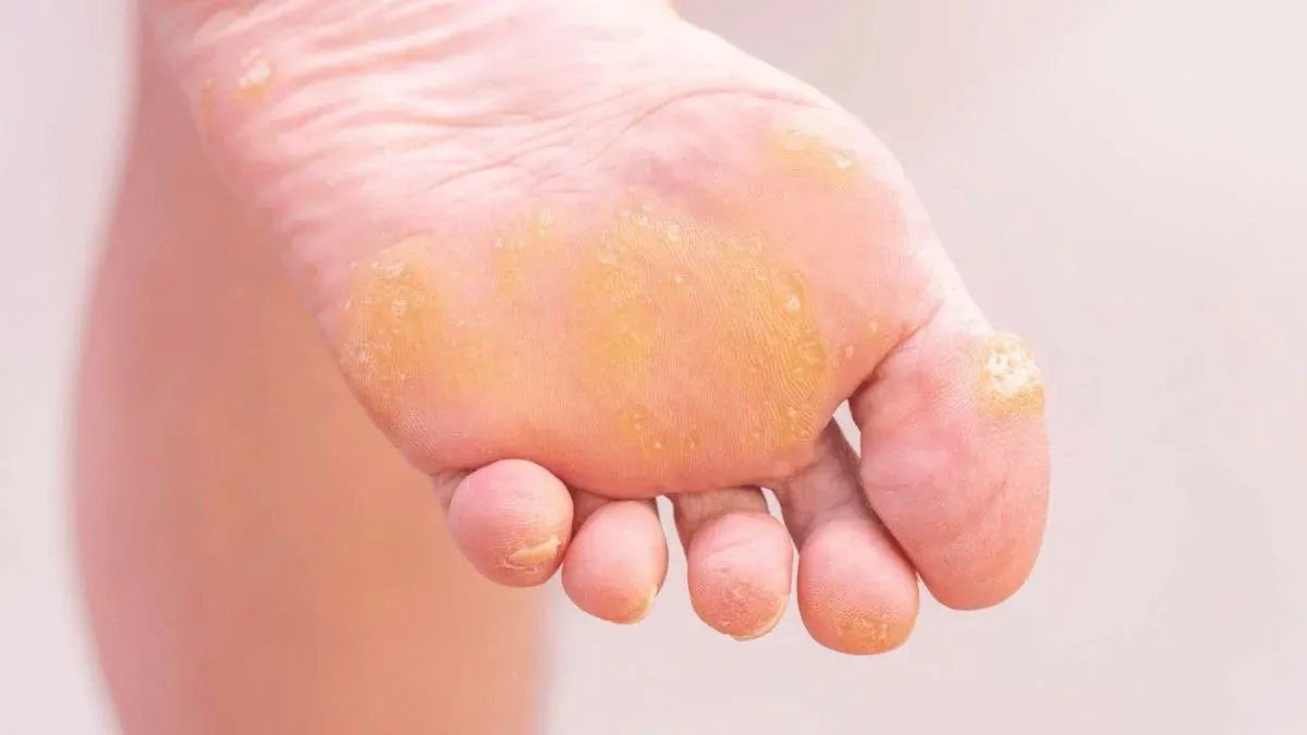 what are foot corns and how to treat them