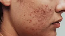 how to make sure your skincare products do not cause acne 