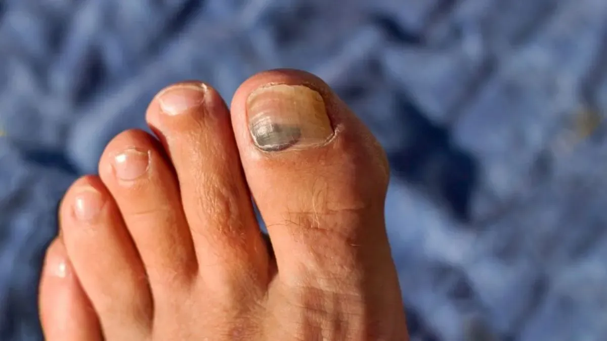 अंगूठे का नाखून काला पड़ रहा है? तुरंत अपना जूता बदलें - what is runner's  toe and how to treat it - The Lallantop Article