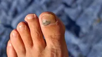 what is runner's toe and how to treat it 