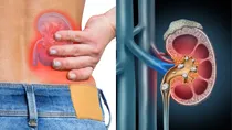 kidney stone and its treatment 