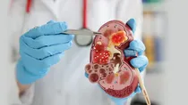 what is Creatinine, that damages your kidneys and cause renal failure