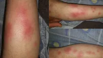 erythema_nodosum_sehat