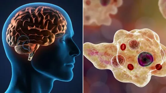 brain-eating amoeba infection 