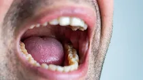 wisdom_tooth_ache