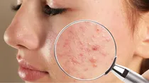 what causes acne and oily skin in monsoon and how to treat it