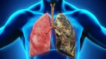 Pneumoconiosis