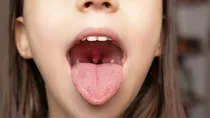 Oral cancer