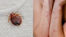 bedbug bites