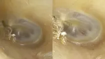 woman complained of abnormal sounds in ear later found spider in her ear