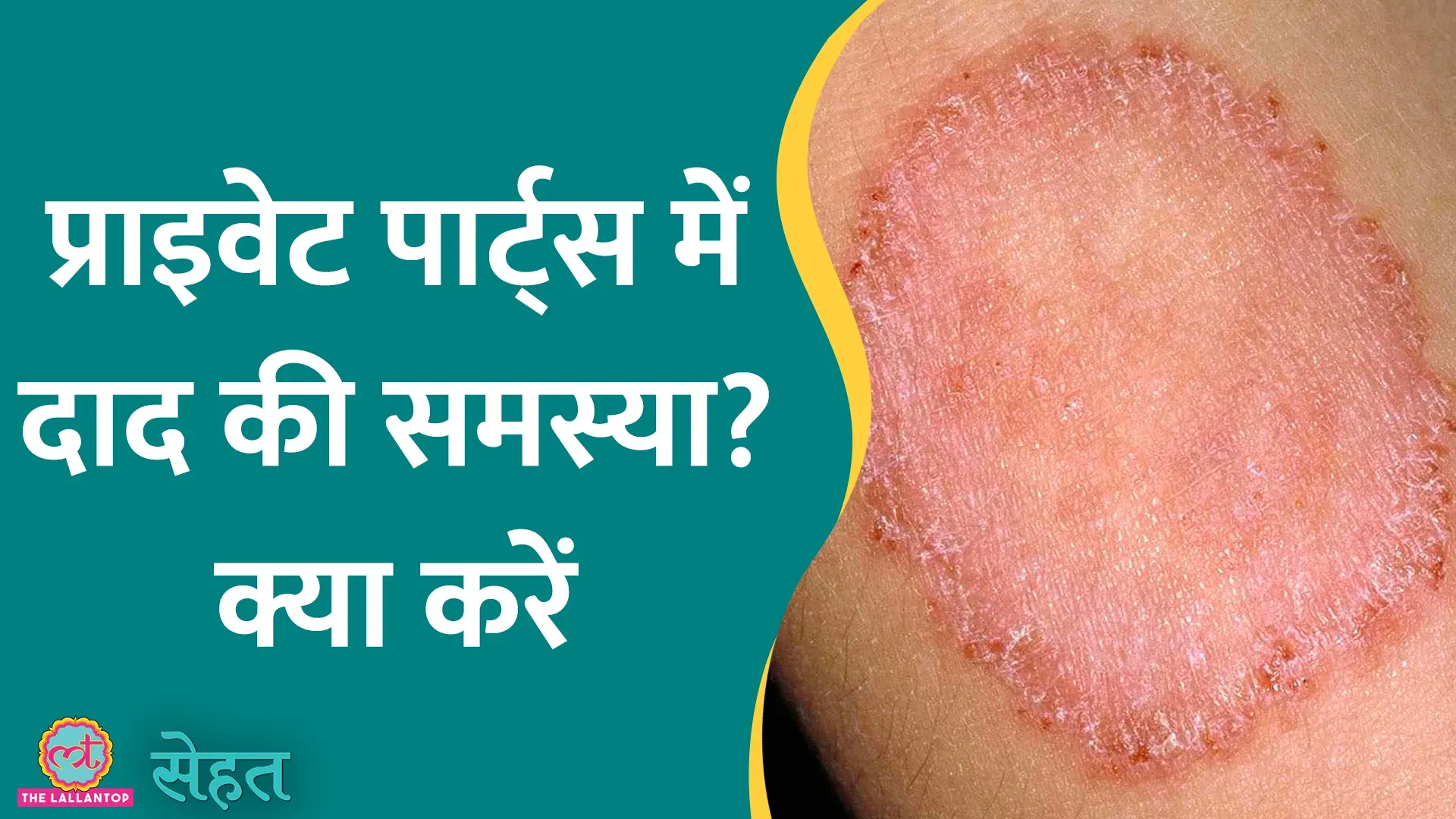 सेहत रिंगवर्म यानी दाद होना आम बात है, क्या ये एक इंसान से दूसरे इंसान