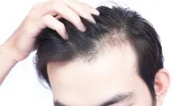 hair_thinning
