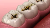 why eating sweets and dessert is bad for your oral health and causes cavities
