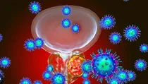prostate cancewr