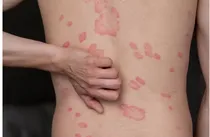Dermatomyositis