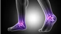 bone spur 
