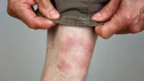 What is Lyme disease and why does it happen its symptoms and treatment 