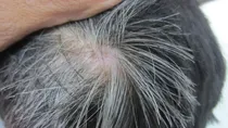 What causes white hair at early age how to prevent premature greying of hair