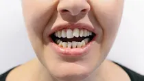 crooked teeth treatment