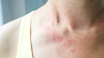 home remedies for prickly heat rash