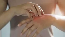 tips for preventing scabies skin infection in monsoon season 