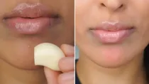 Is it good to rub garlic on your acne