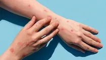 India reports first case of Clade 1 b variant of Mpox