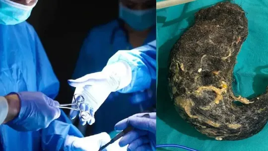 bareilly woman surgery viral doctors found two kilo hair bunch in stomach during operation