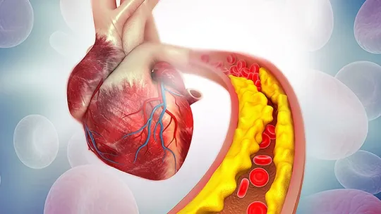 What are the causes of plaque buildup in arteries of the heart