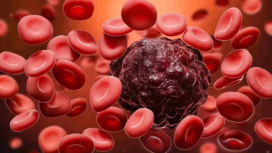 what is leukemia blood cancer its causes symptoms and treatment