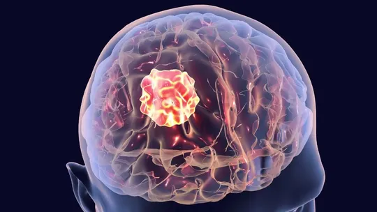 what causes brain tumor and how to prevent it doctor explains 