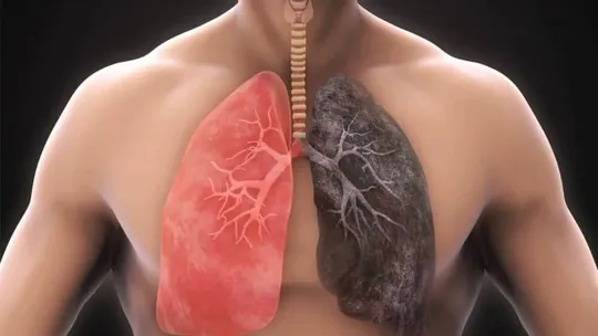 myths related to chronic obstructive pulmonary disease copd