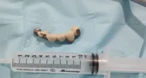 Visakhapatnam A 52 year old man swallowed his own teeth while sleeping