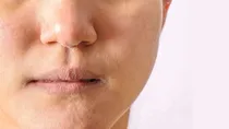 dry skin acne causes treatment winter skin care tips