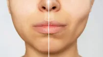 know everything about buccal fat removal cosmetic surgery