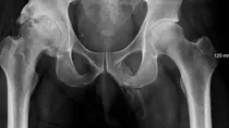 Man Private Part Turning Into a Bone Penile Ossification Peyronie Disease Scar Tissue