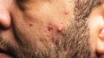 know everything about hormonal acne in hindi 