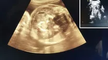 Fetus in Fetu Sonography