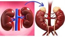 horseshoe kidney causes symptoms prevention and treatment
