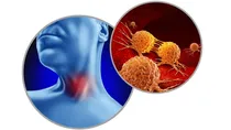 Oral sex and throat cancer causes symptoms prevention and treatment